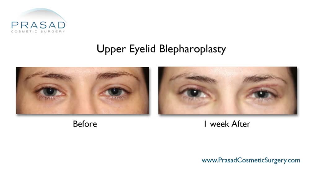 Photos one week after eyelid surgery - upper blepharoplasty