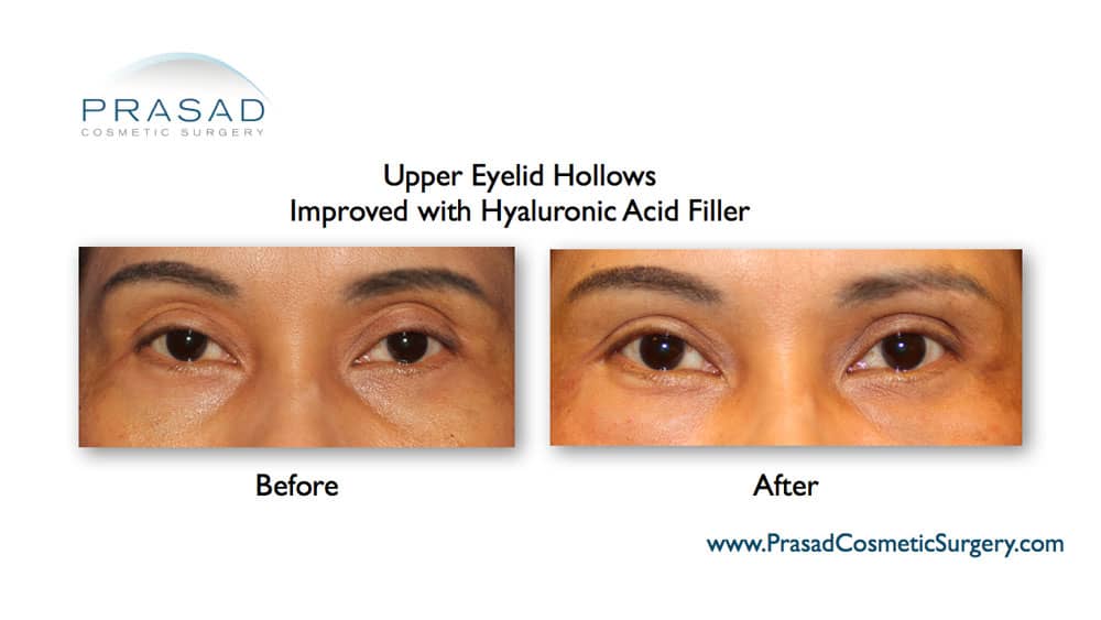 upper eyelid hollows improved with dermal filler before and after