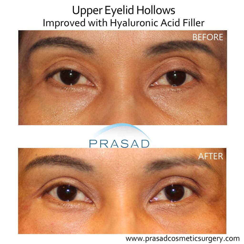 upper eyelid hollows improved with filler before and after