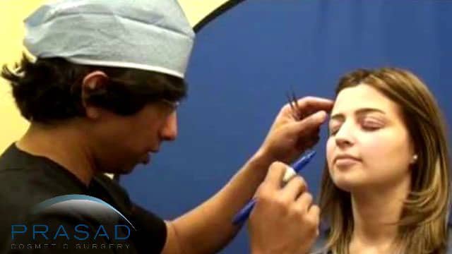 upper blepharoplasty preparation