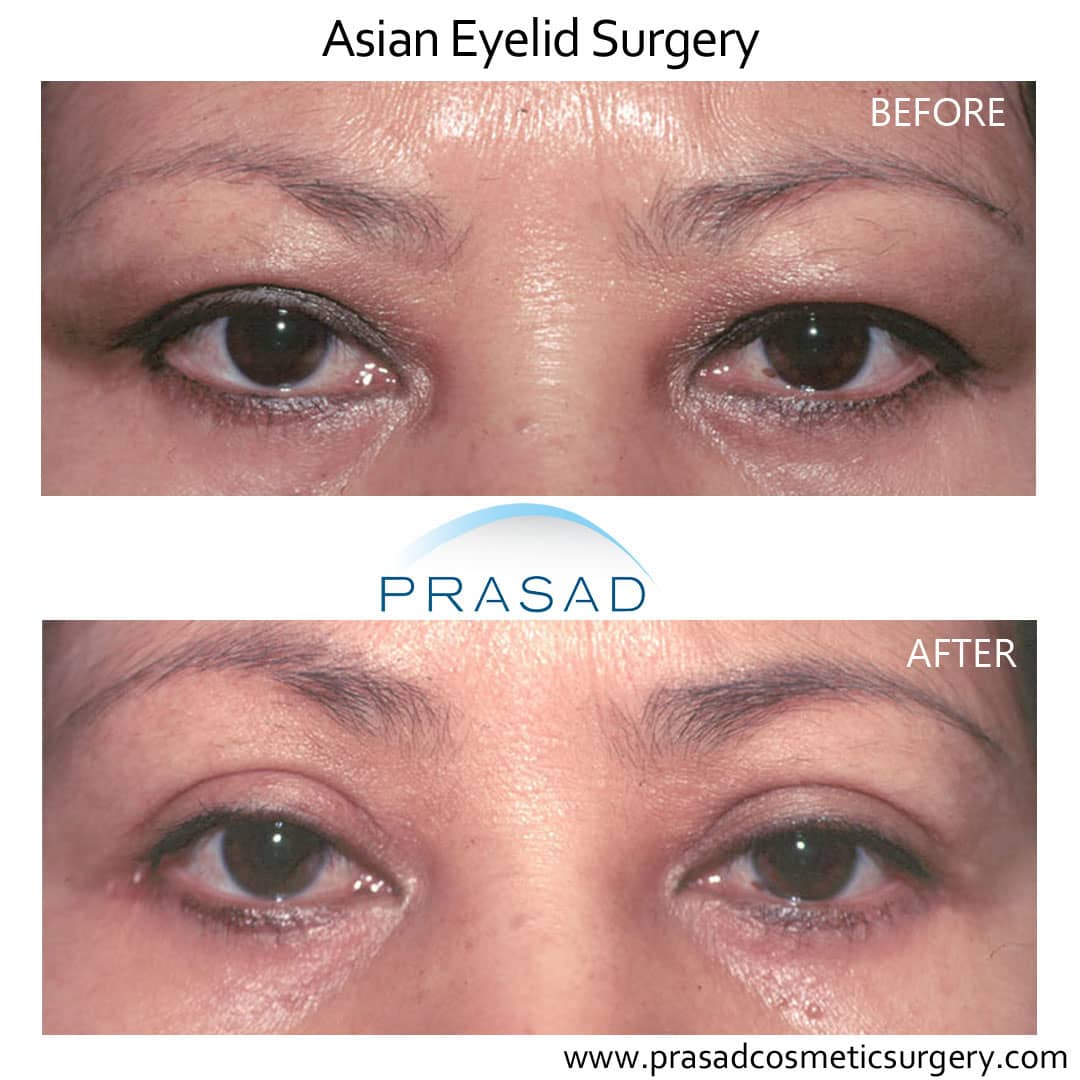 Asian double eyelid blepharoplasty before and after