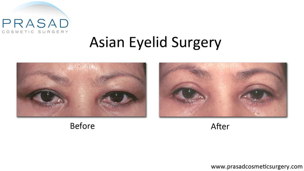 Asian eyelid surgery before and after