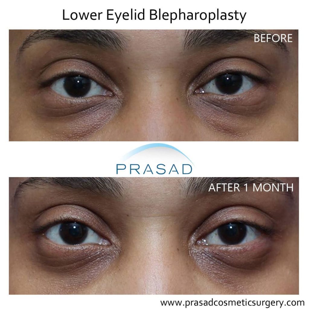 lower blepharoplasty before and after young african-american woman