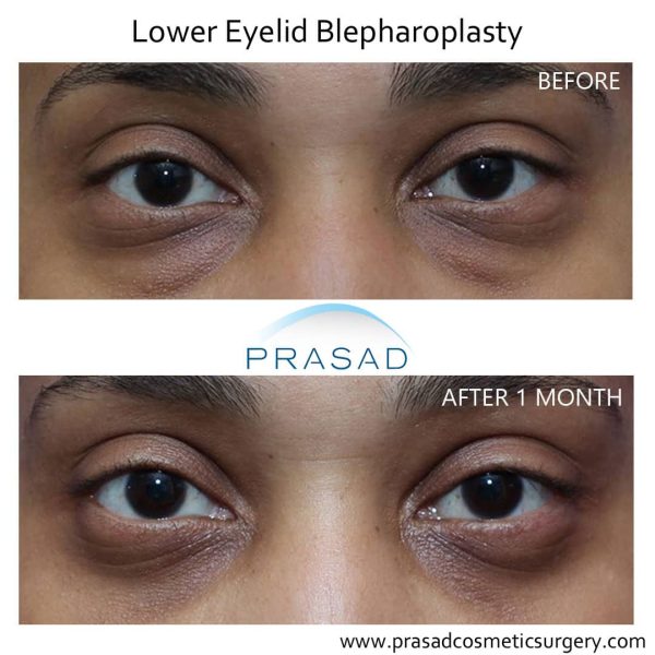 What is the Best Procedure for Bags Under Eyes? Dr. Prasad