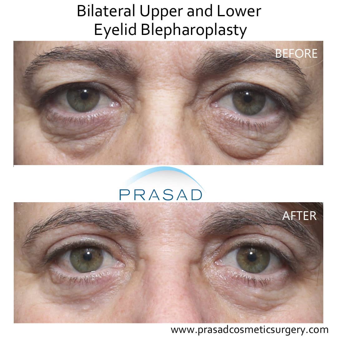 upper and lower blepharoplasty before and after procedure by Dr Prasad