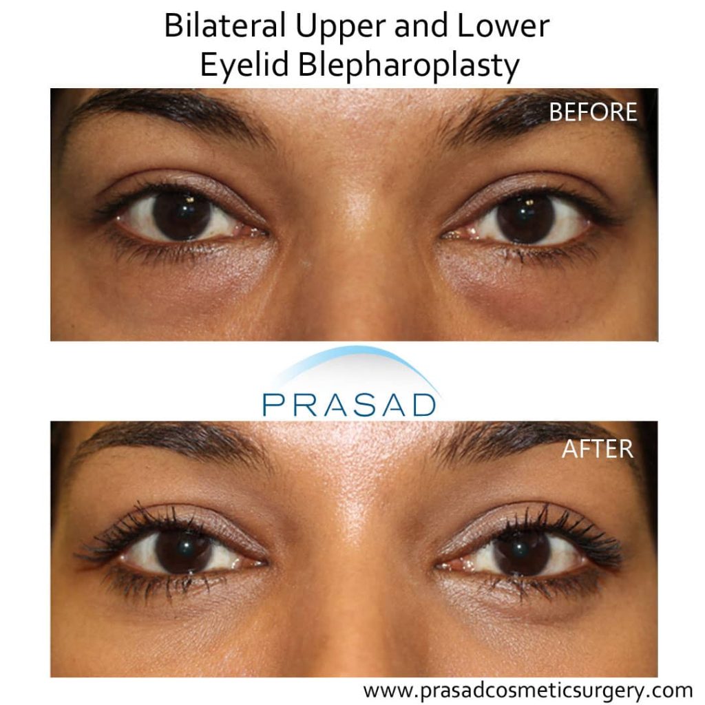 upper and lower blepharoplasty before and after