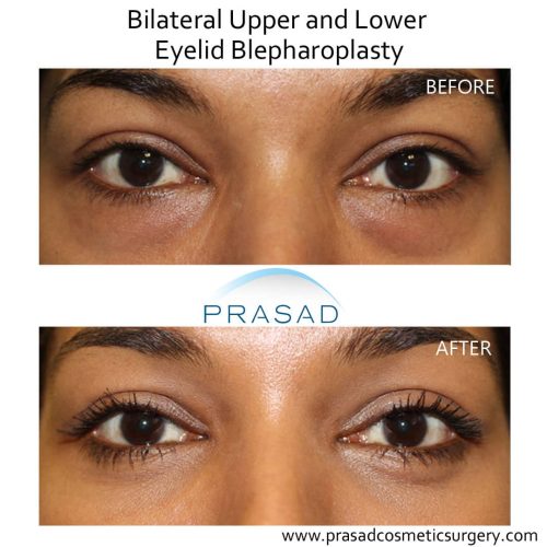 Blepharoplasty Before and After Photos | Prasad Cosmetic Surgery