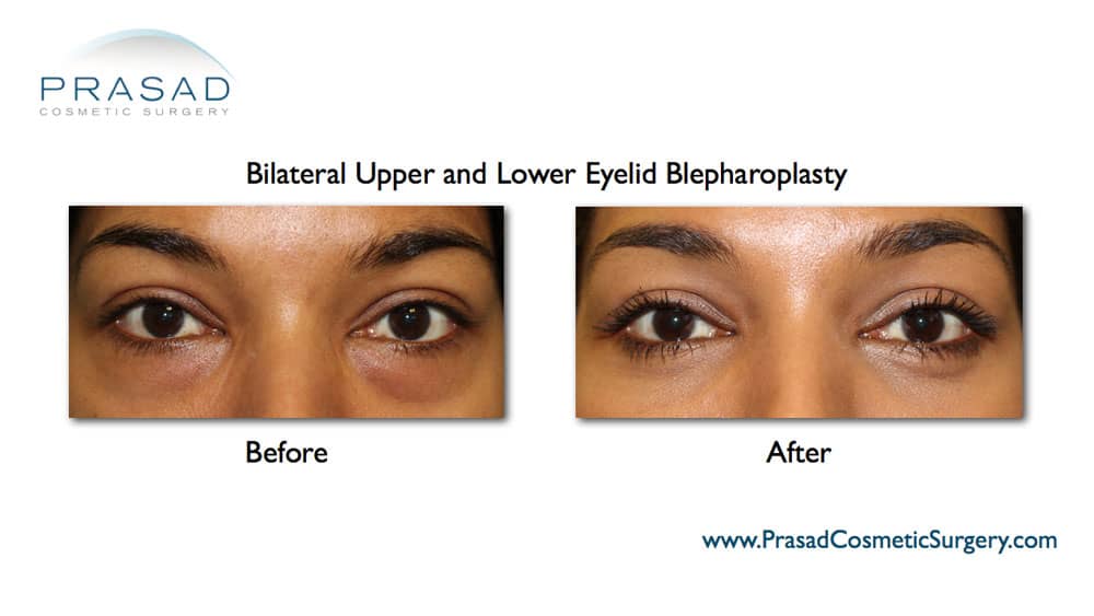 upper and lower lid blepharoplasty before and after
