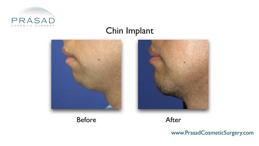 chin implant before and after male procedure done at Prasad Cosmetic Surgery NYC