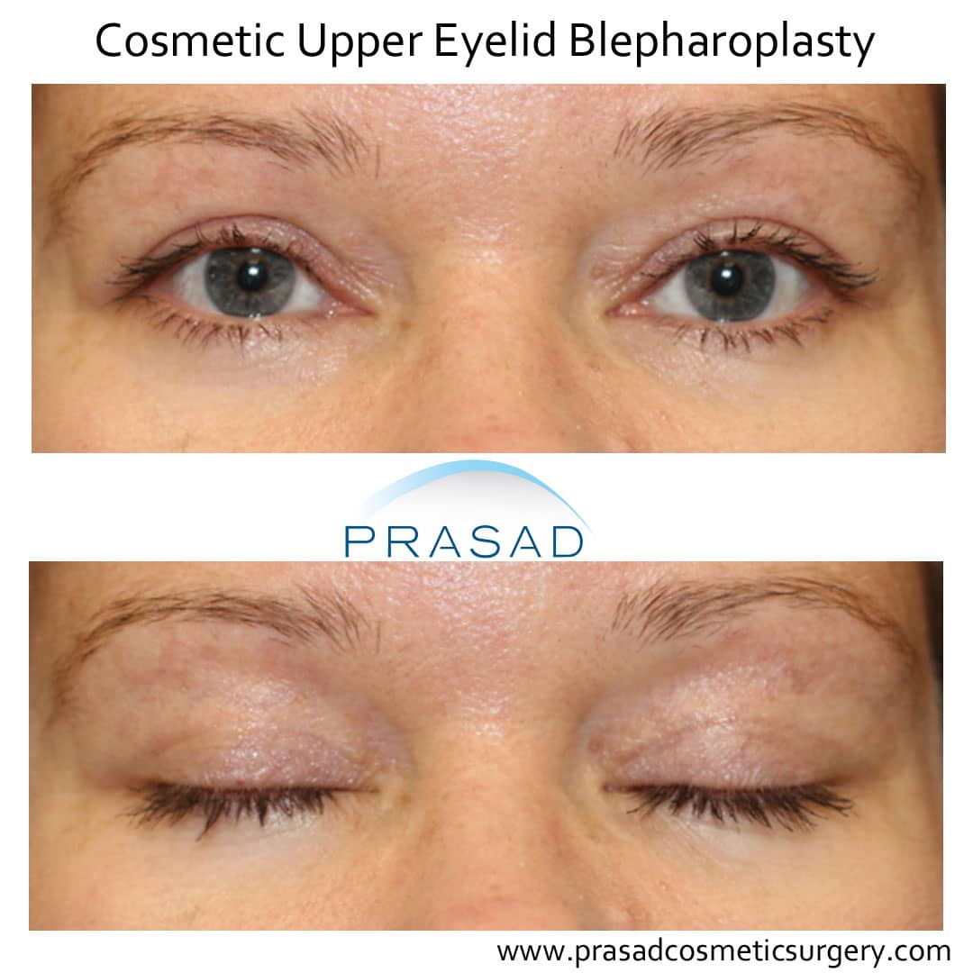 cosmetic upper eyelid surgery healing eyes