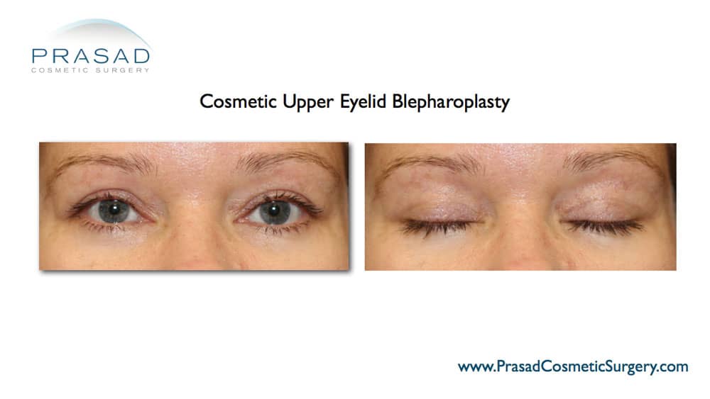 upper eyelid surgery complete recovery