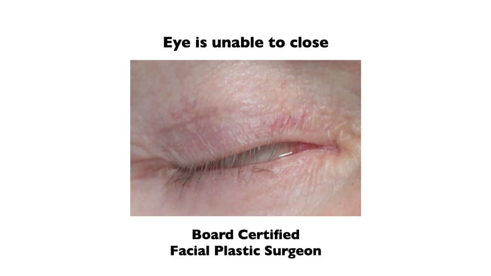 upper blepharoplasty gone wrong - eye is unable to close
