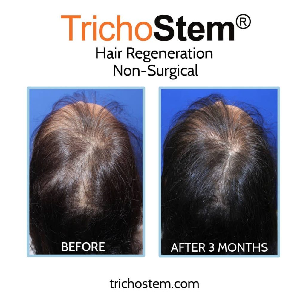When Women Can Have a Hair Transplant? | Dr. Prasad Blog