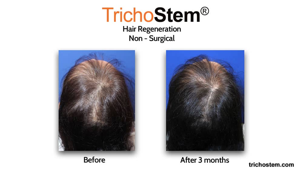 hair regeneration for female pattern hair loss treatment before and after 3 months