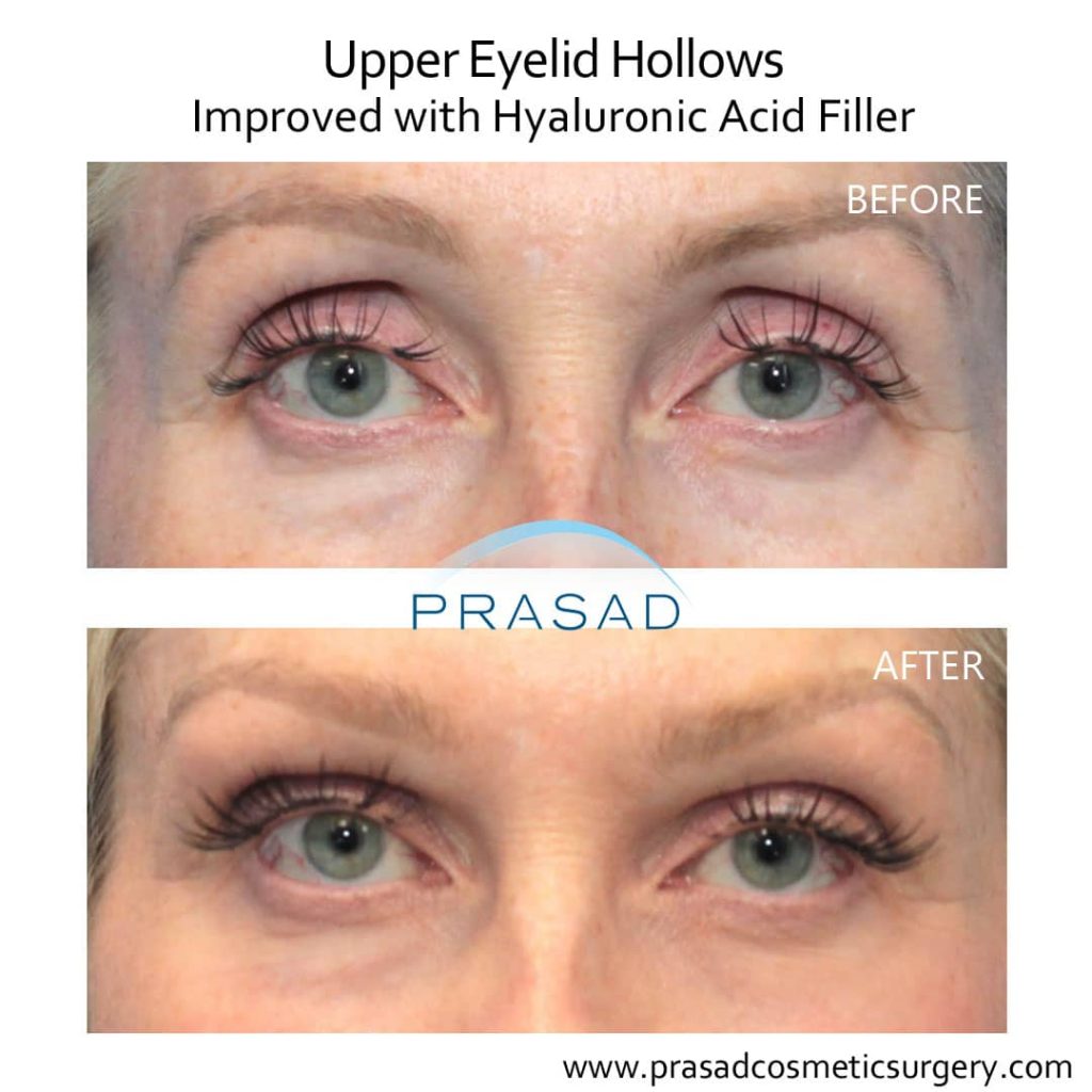 upper eyelid hollowing before and after filler