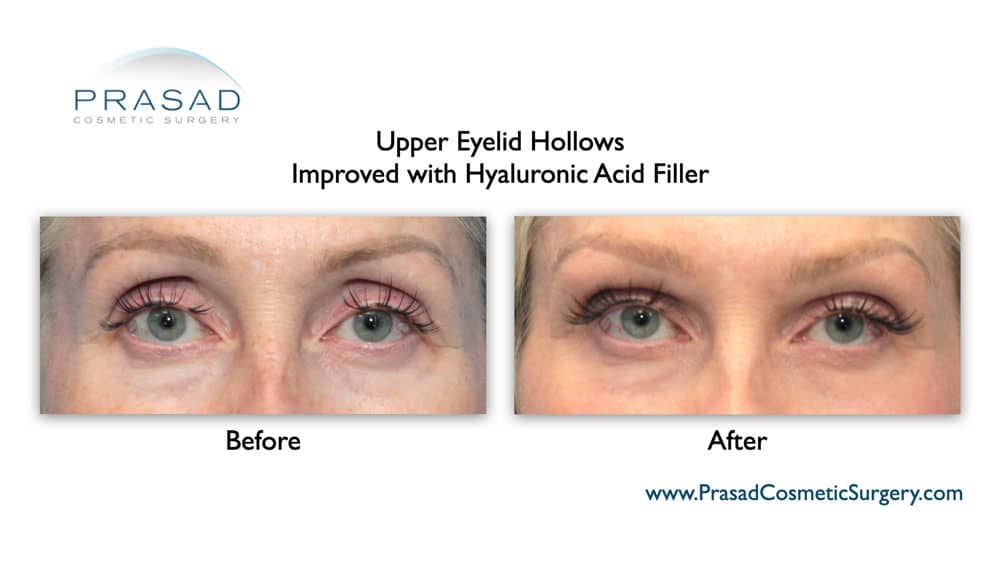 upper eyelid hollowing before and after treatment with filler