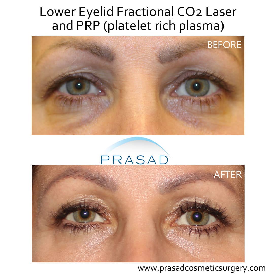 lower eyelid surgery with fractional laser and PRP under eyes before and after