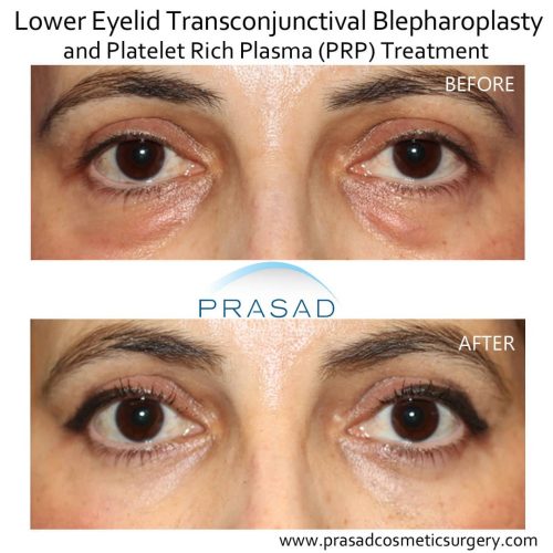 Why PRP or Lasers Don’t Work for Puffy Under Eye Bags