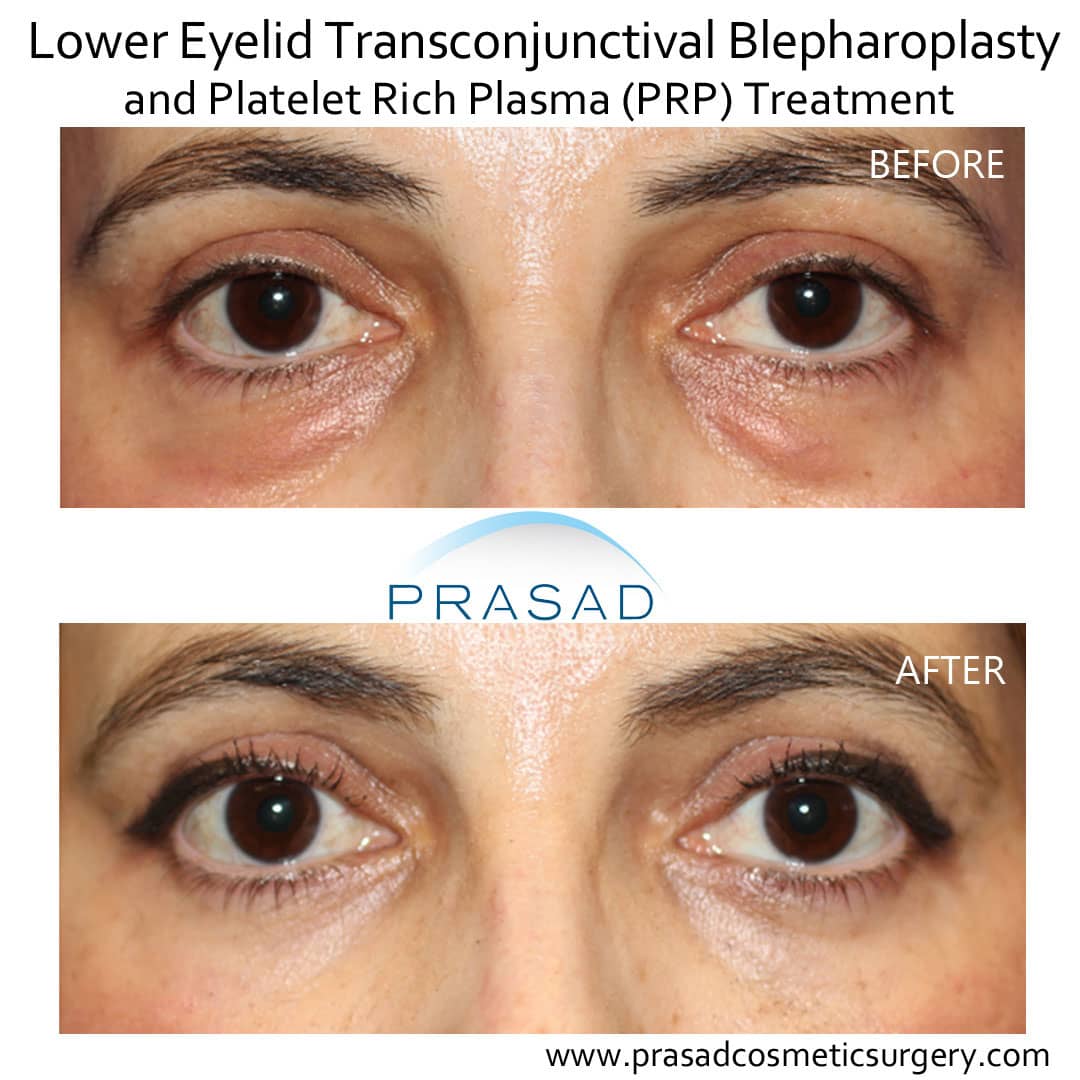 lower eyelid blepharoplasty and prp under eyes before and after recovery