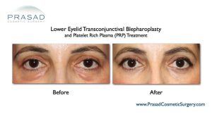 Why PRP or Lasers Don’t Work for Puffy Under Eye Bags