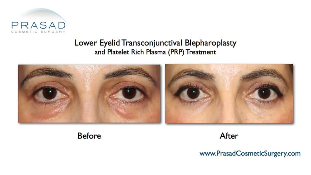 lower eyelid surgery and prp under eyes before and after