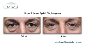 Can Upper Blepharoplasty Go Wrong? Dr. Prasad Blog