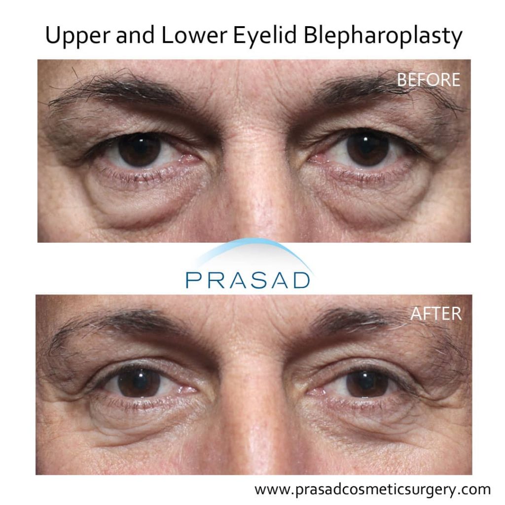 male patient had upper and lower blepharoplasty before and after