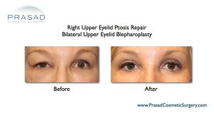 Can Upper Blepharoplasty Go Wrong? Dr. Prasad Blog