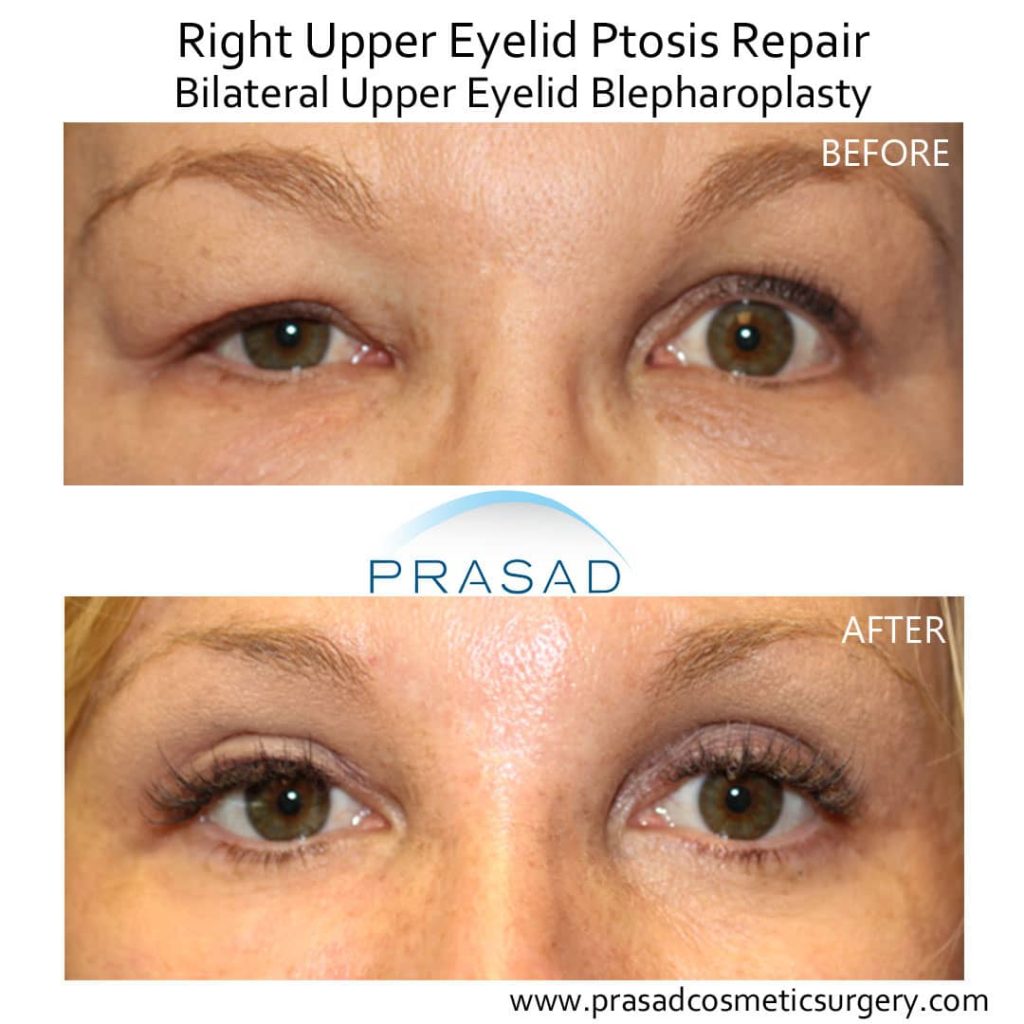 ptosis repair and upper eyelid blepharoplasty before and after