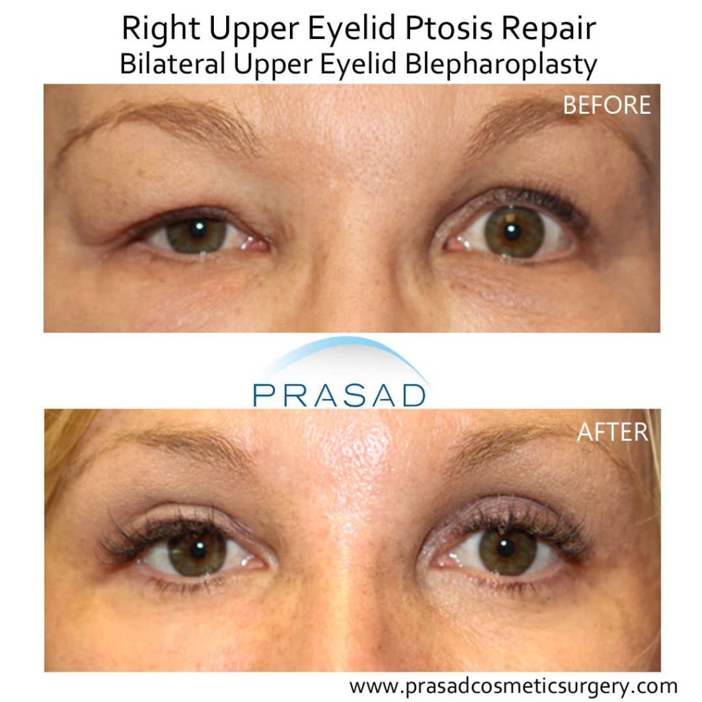 Droopy Eyelid Surgery: Eyelid Ptosis Procedure, And Recovery