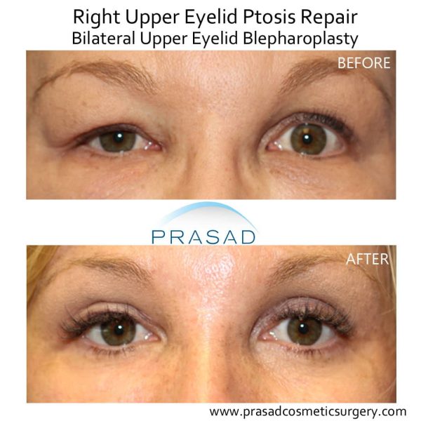 Droopy Eyelid Surgery: Eyelid Ptosis Procedure, and Recovery