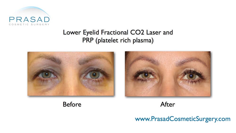 lower blepharoplasty with fractional laser and PRP under eyes before and after
