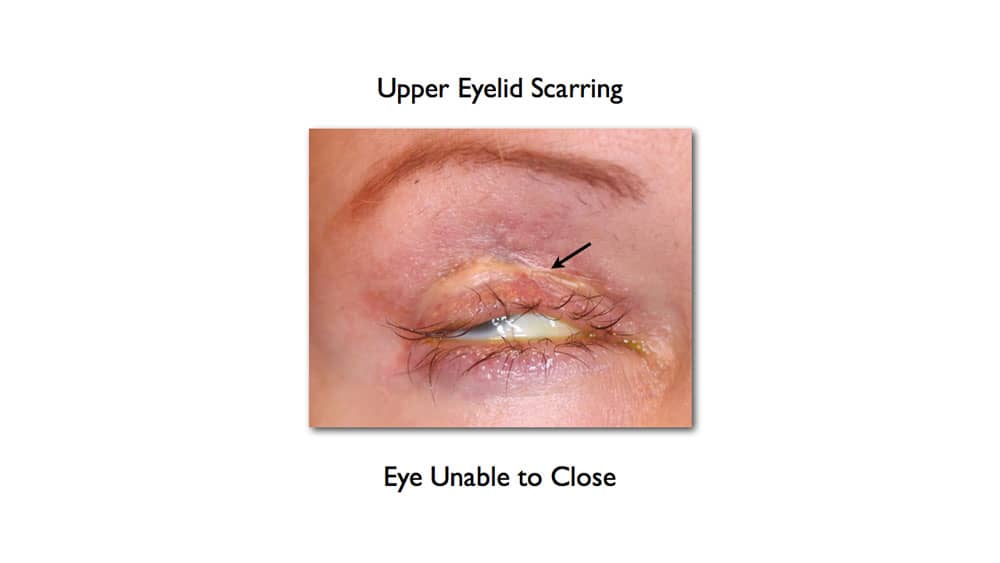 upper blepharoplasty gone wrong - upper eyelid scarring