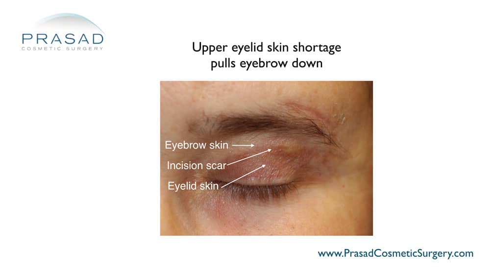 upper blepharoplasty gone wrong: upper eyelid skin shortage