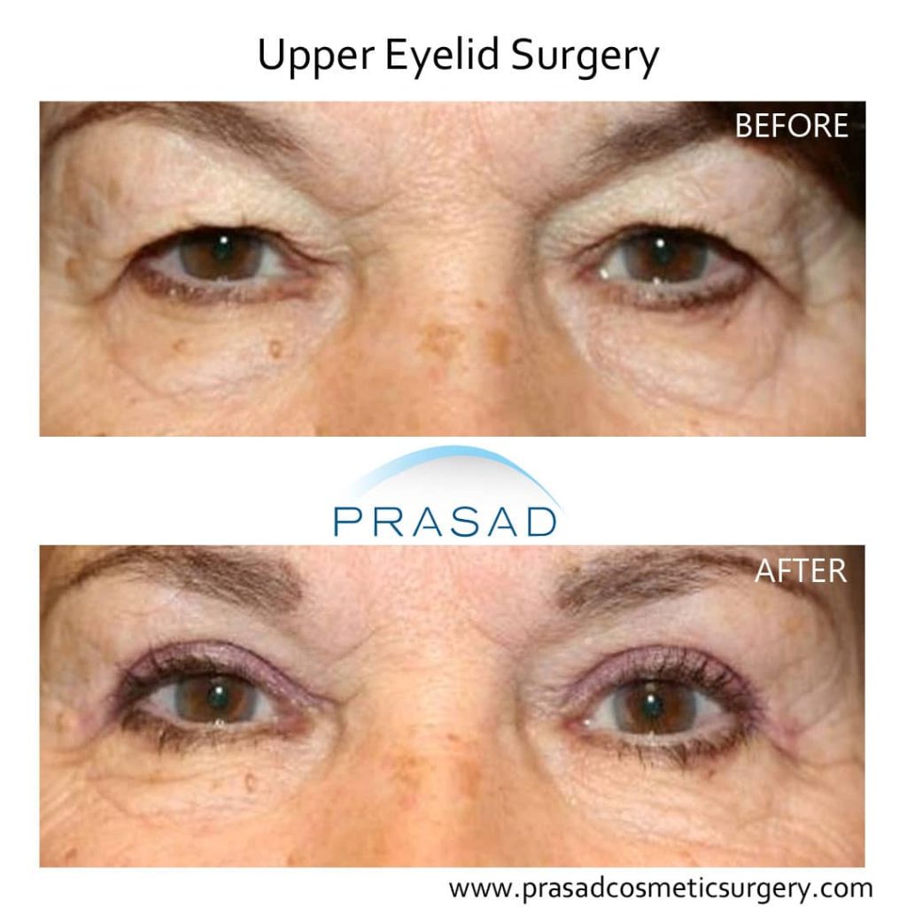 upper lid blepharoplasty before and after picture