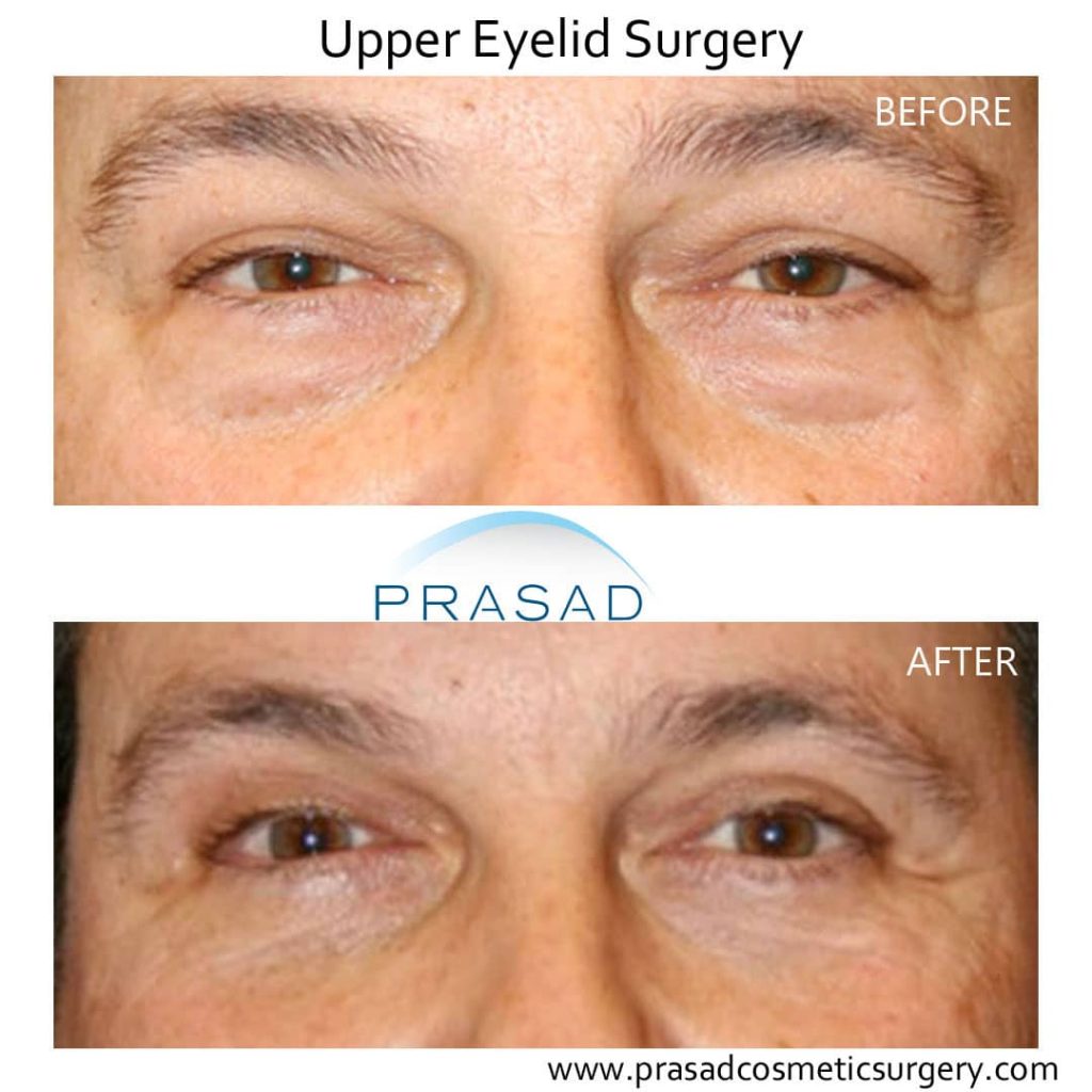 male blepharoplasty before and after recovery photo