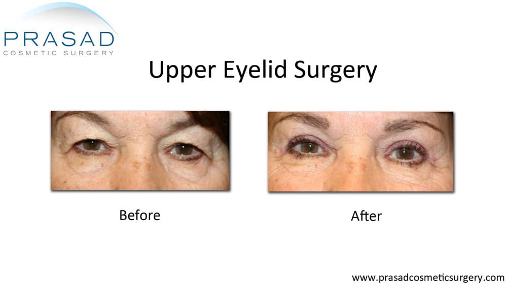 upper eyelid blepharoplasty before and after picture