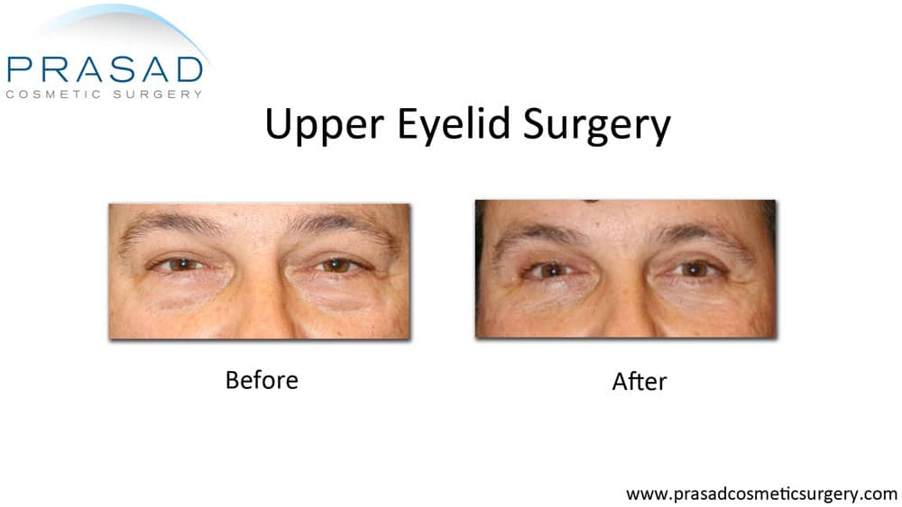 male upper blepharoplasty before and after