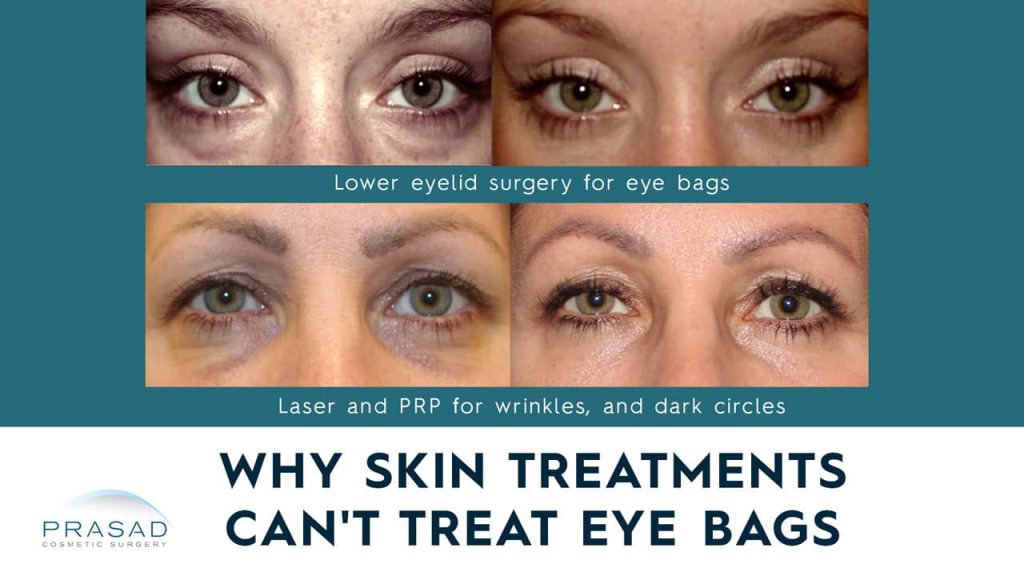 Why Lasers or PRP Under Eyes Don’t Work for Puffy Under Eye Bags