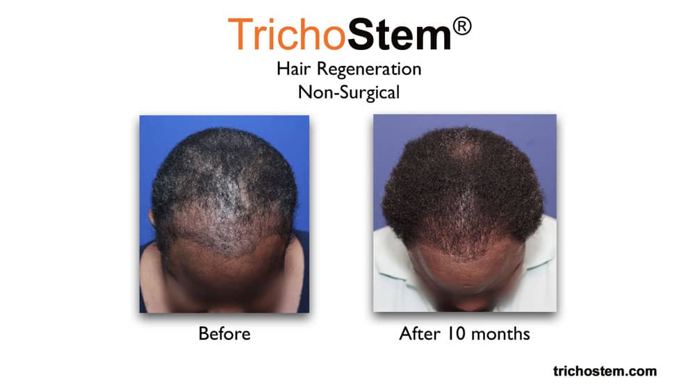 Hair Regeneration for female hair loss treatment before and after 10 months success results