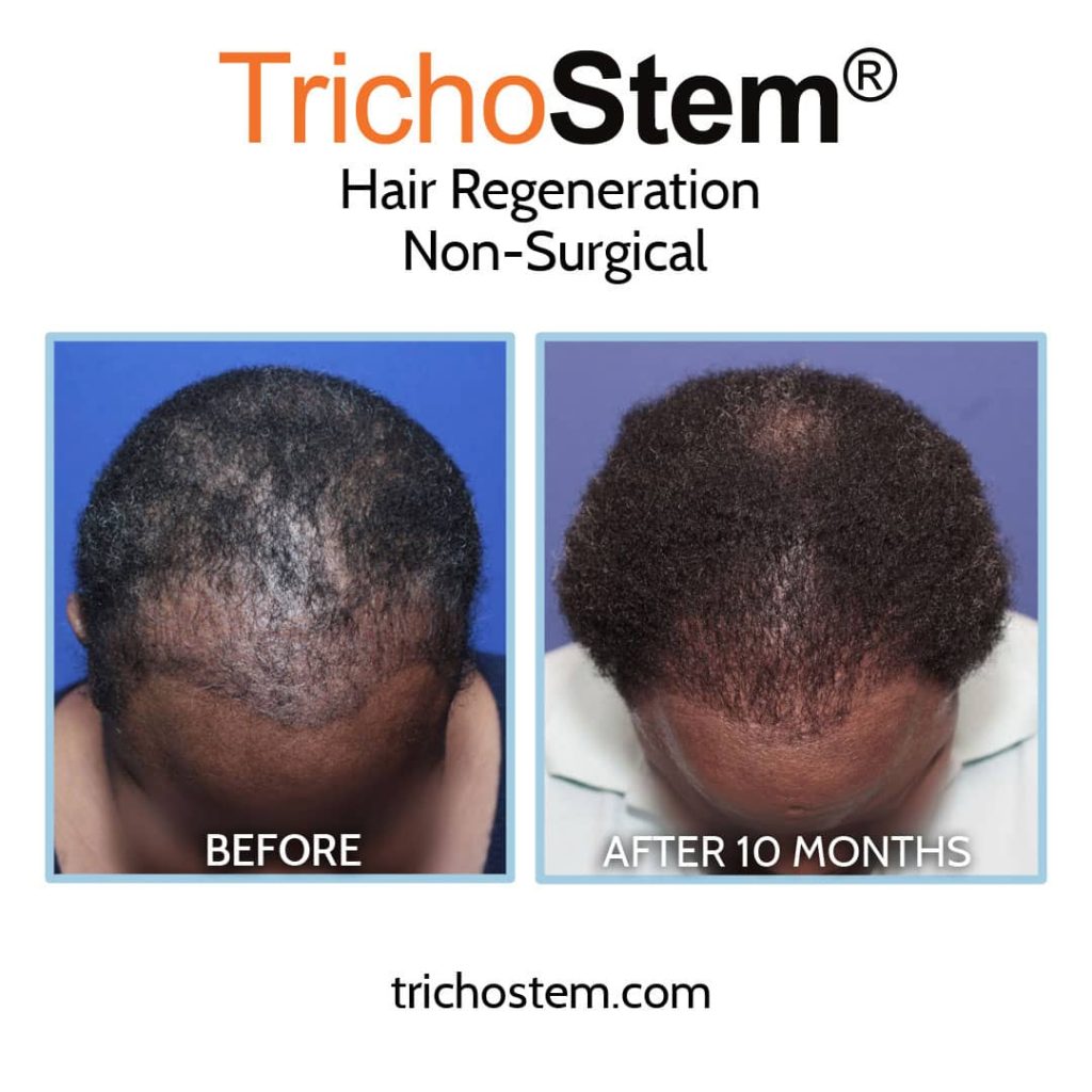Hair loss treatment for women before and after success results