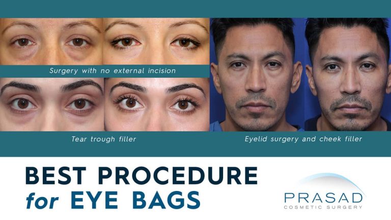 What is the Best Procedure for Bags Under Eyes