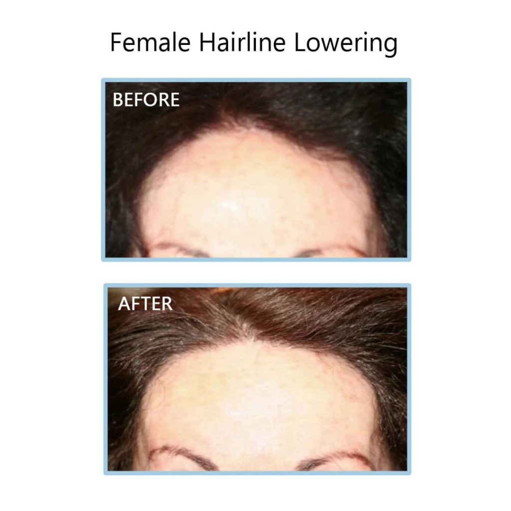 Female hairline lowering treatment before and after