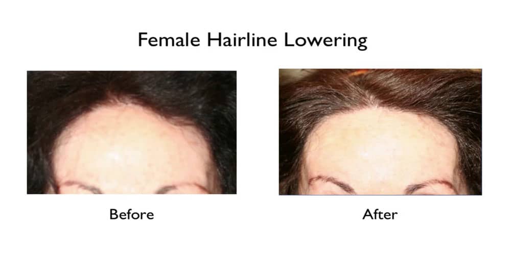 female hairline lowering treatment