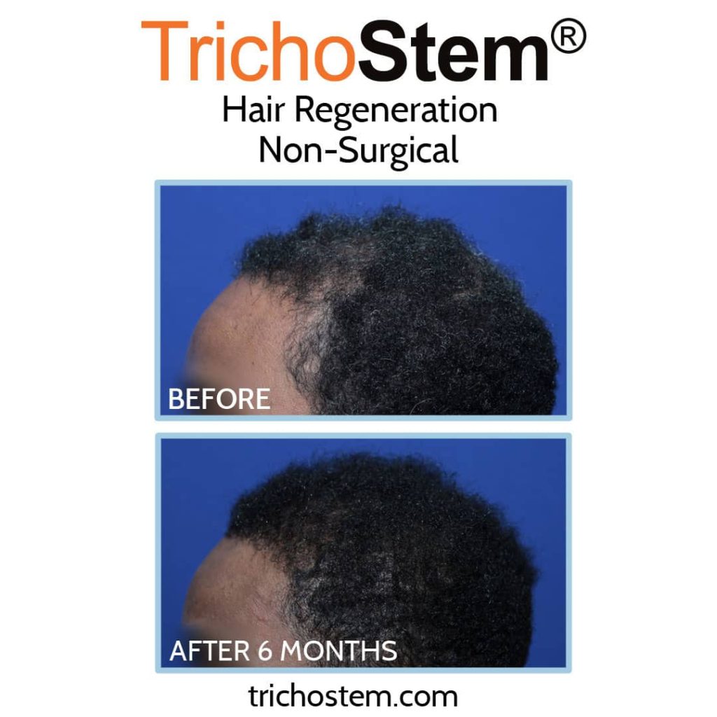 Hair Regeneration for traction alopecia treatment before and after 6 months