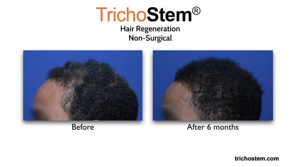 Hair Regeneration for female hair chemical burns before and after 6 months
