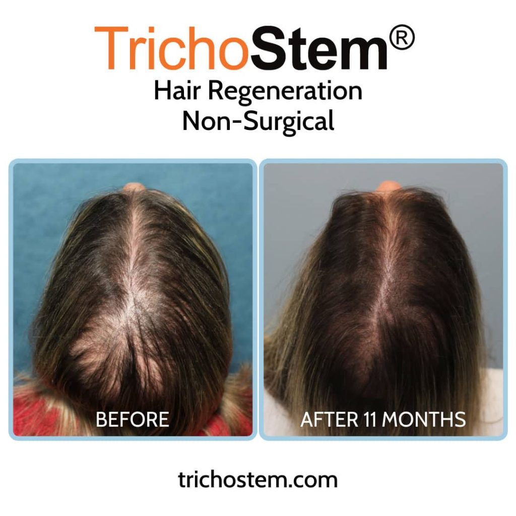 Hair regeneration for women's hair loss before and after 11 months