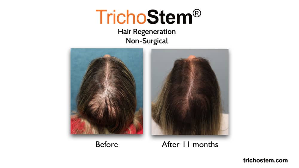 Hair Regeneration for female pattern hair loss before and after 11 months