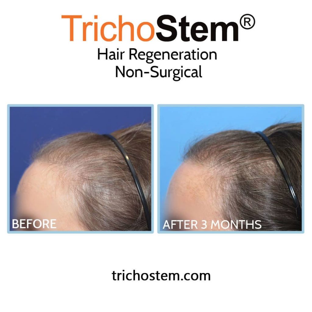 Hair Regeneration for woman's thinning hair before and after 3 months