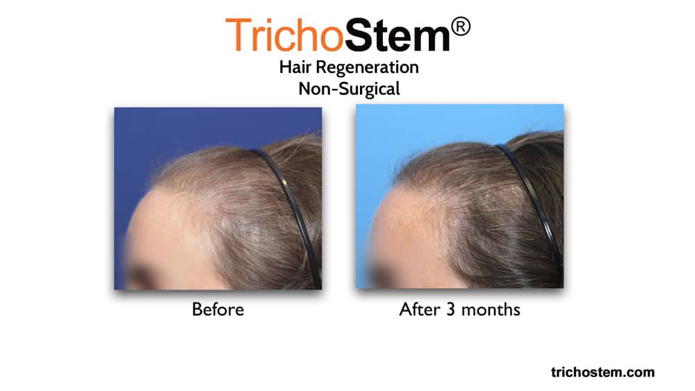 Hair Regeneration treatment for female thinning hair before and after 3 months